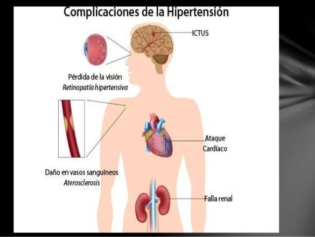 hipertension arterial sistemica